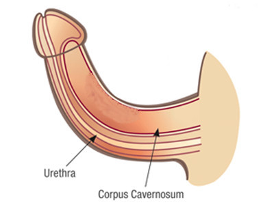 kidney stone disease 1